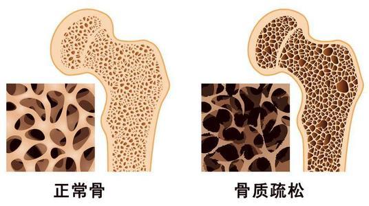 出生體重與以后的骨質(zhì)疏松癥風(fēng)險有關(guān)