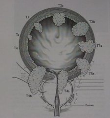 中山大學(xué)林天歆團(tuán)隊揭示膀胱癌淋巴轉(zhuǎn)移提供系統(tǒng)性的解決策略