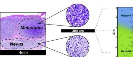 MicroRNA生物標(biāo)志物使黑色素瘤的診斷更加客觀