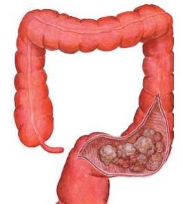 結(jié)腸癌由細菌和細胞應(yīng)激推動