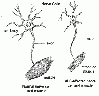 科學(xué)家發(fā)現(xiàn)與ALS嚴(yán)重程度有關(guān)的遺傳變異