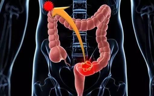 自然療法和當前療法可以改善結(jié)腸癌的治療