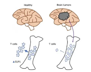 腦癌可通過(guò)在骨髓中捕獲T細(xì)胞來(lái)抵抗免疫治療