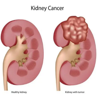 研究人員確定了七種腎癌的起源