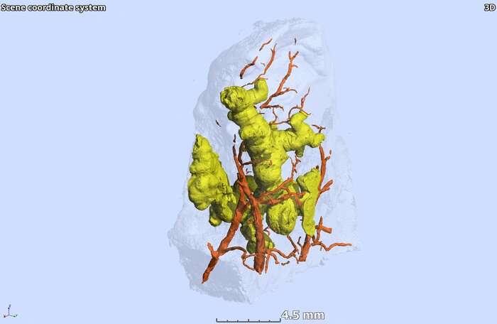 結(jié)核病肉芽腫的第一個(gè)3-D視圖改變了它們的形狀和形成的范式