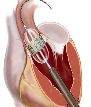 癡呆患者主動脈瓣置換的趨勢