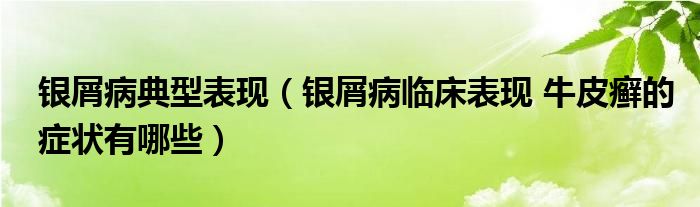 銀屑病典型表現(xiàn)（銀屑病臨床表現(xiàn) 牛皮癬的癥狀有哪些）