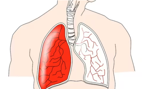 研究：痰的顏色可以預(yù)測肺病患者的預(yù)后