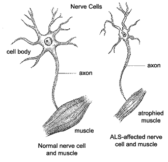 醫(yī)學(xué)科學(xué)家已經(jīng)鑒定出一種分子是一種治療ALS的新化合物