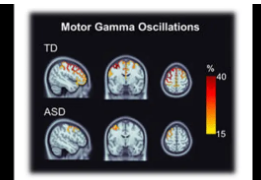 自閉癥兒童的腦電活動變化