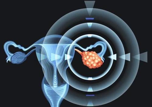 研究人員正在開發(fā)一種基于抗體的方法來摧毀致命的卵巢癌