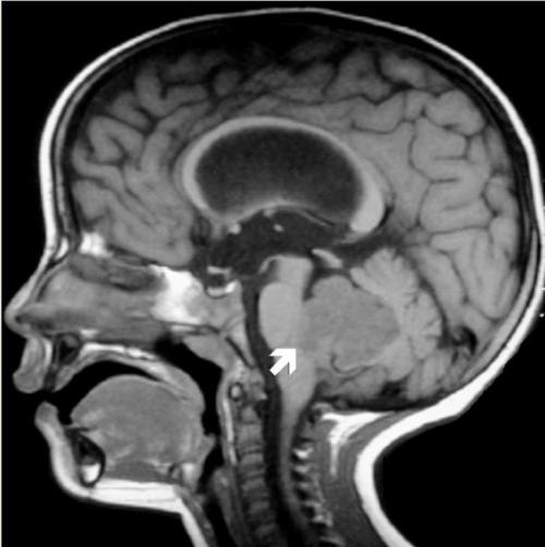 研究人員呼吁對兒童腦癌進行常規(guī)基因篩查