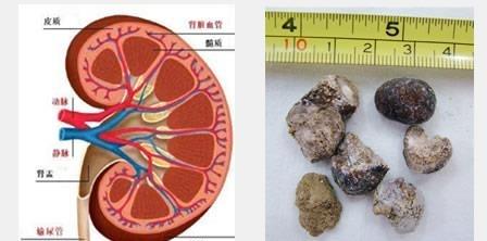 研究揭示了與腎結(jié)石相關(guān)的新遺傳因素