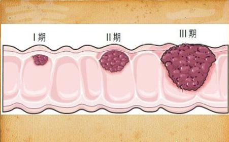 分析結(jié)腸癌蛋白和基因揭示了新的潛在治療方法